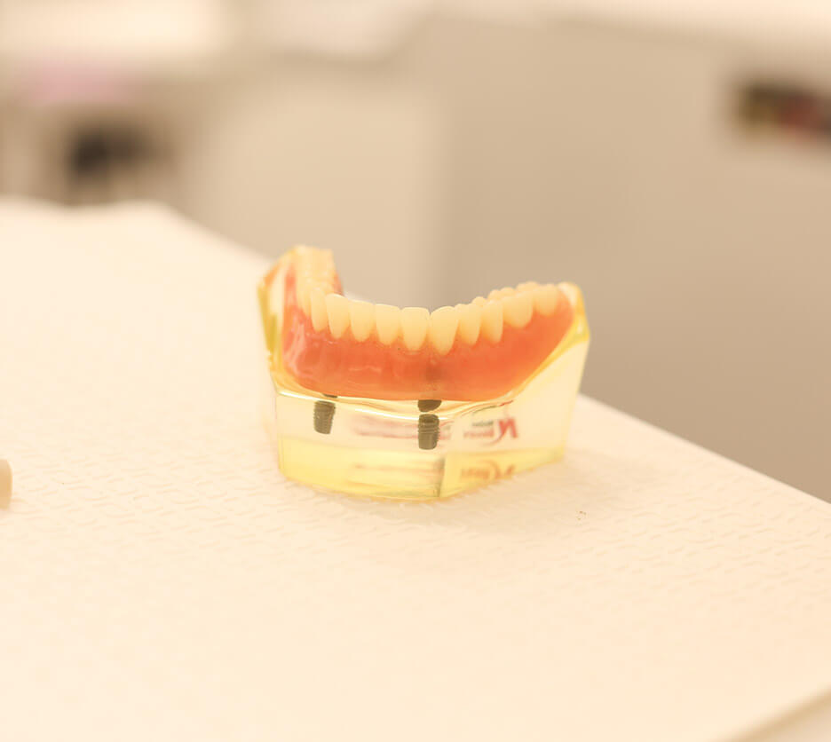 set of complete dental implants