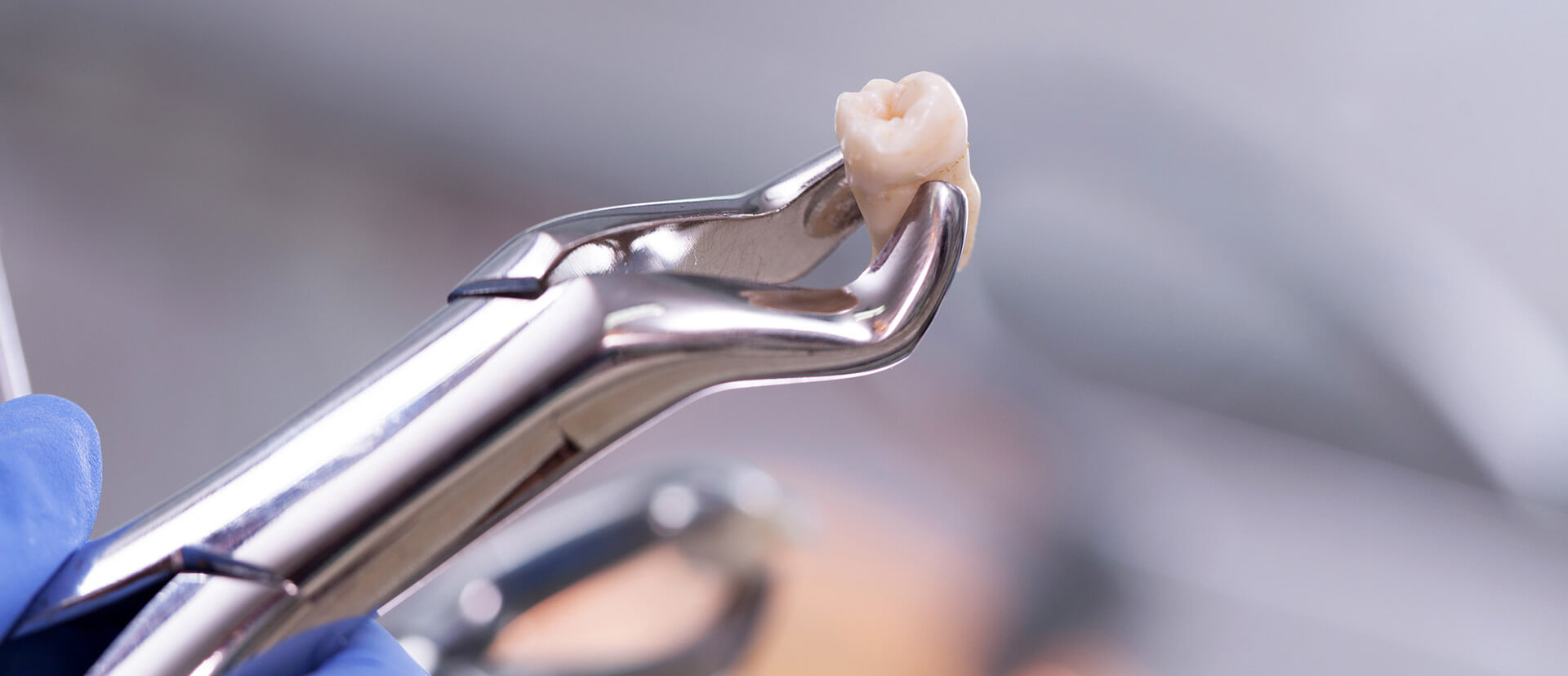tooth extraction after wisdom teeth removal