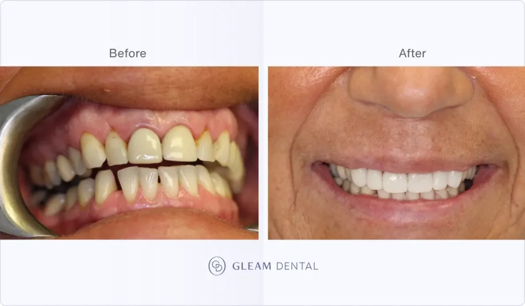 Before and after photo of an adult showing dental crown treatment with restored tooth shape and color.