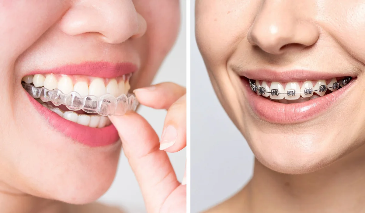 Close-up comparison of adult teeth with clear Invisalign aligners on the left and traditional metal braces on the right.