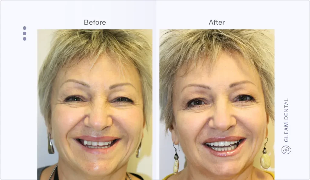 Before and after photo of an adult with veneers correcting discoloration, uneven teeth, and minor gaps for a brighter smile.