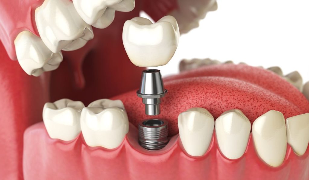 dental implants illustration 