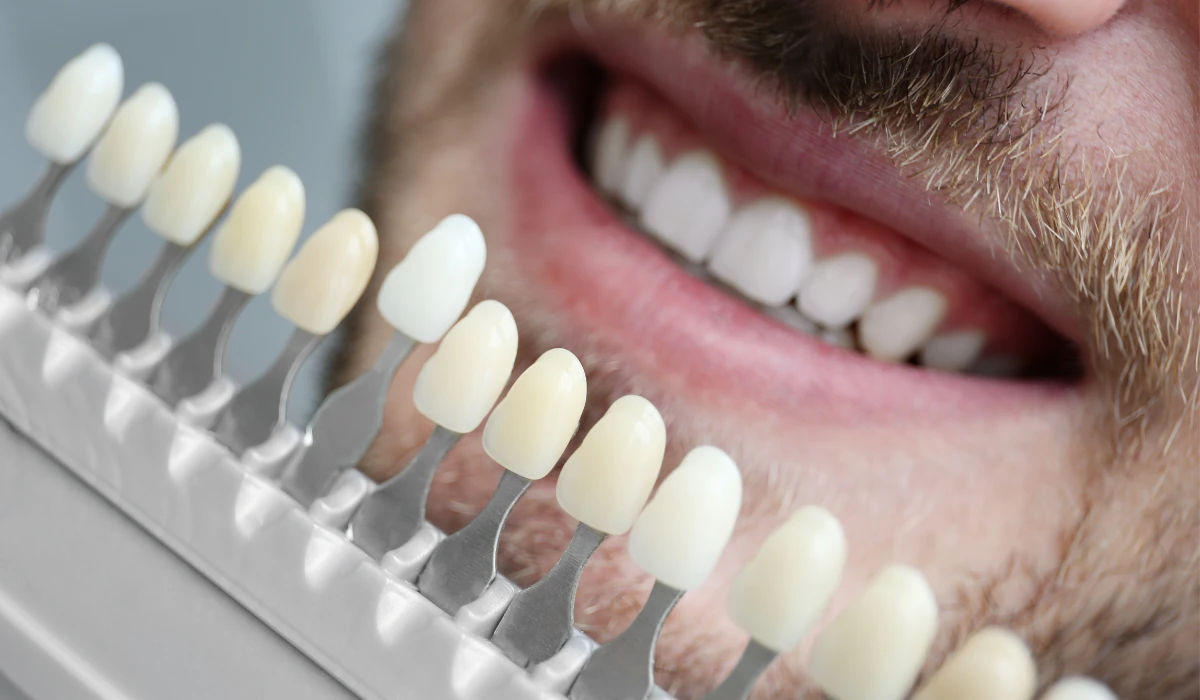 Close up of a dental veneer shade sample beside a patient’s smile.