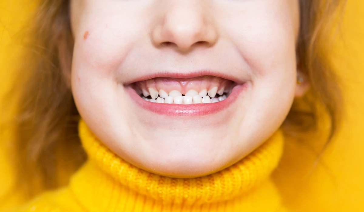 A child smiling, showing an underbite.