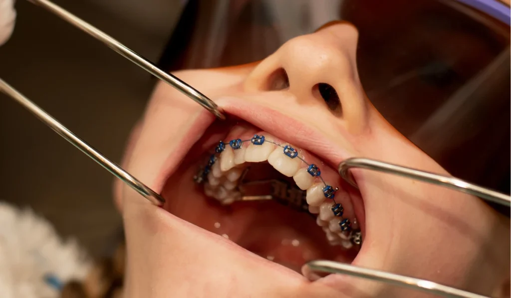 Palatal expander orthodontic procedure