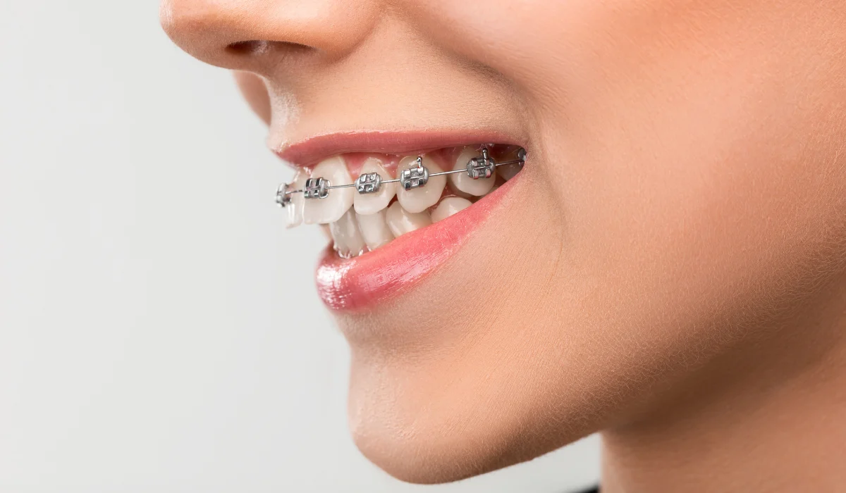 Close up of a patient with an overbite wearing metal braces