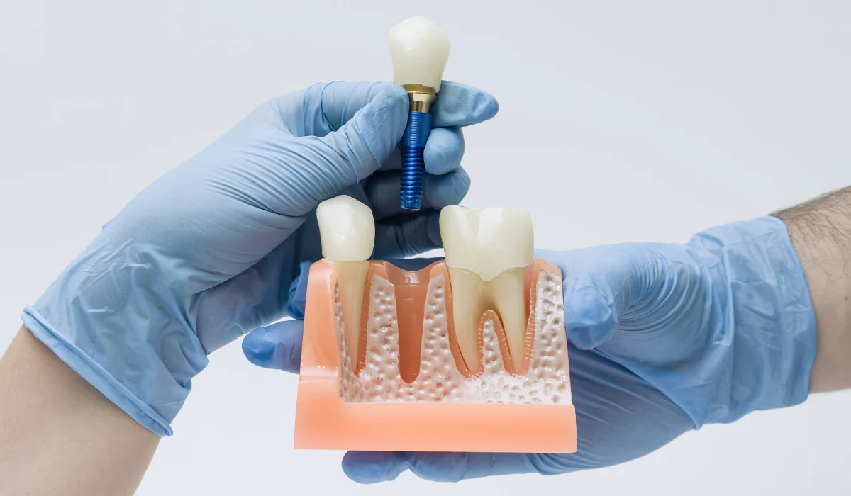 Dental implant model showing how an implant replaces a missing tooth